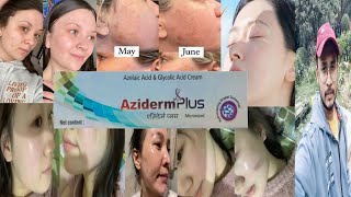 Aziderm Plus  Honest Review [upl. by Allecsirp]