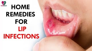 Home Remedies For Of Lip Infections  Health Sutra [upl. by Lamee]