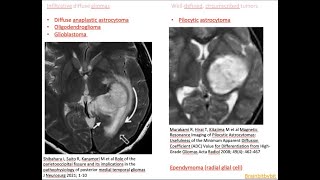 59 Glial tumors  introductionoverview primary brain tumor glioma WHO classification 2021 [upl. by Norraj]