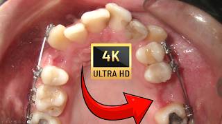 Ectopic canines in ADULTS and WISDOM tooth eruption Braces time lapse [upl. by Ylluz]