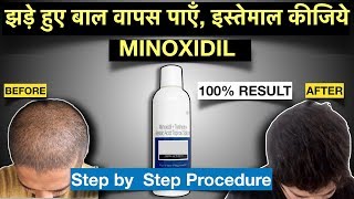 MINOXIDIL for Hair Regrowth in Hindi  Know How To Apply Correctly [upl. by Ydarg919]