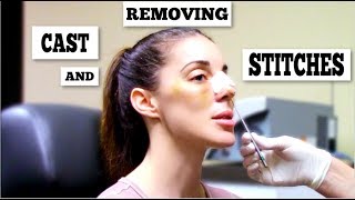 Cast Removal Big Reveal Nose Job Under Eye Fat Transfer Day8 post op V25 [upl. by Aluin]