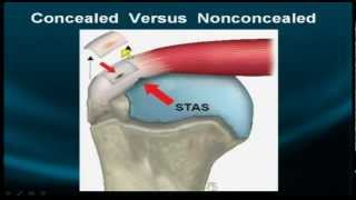 Shoulder MRI Rotator Cuff  Part IIa [upl. by Neitsirk969]