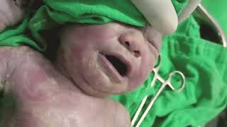 Cleen Vernix Caseosa  Cord cutting  how to cleen vernix caseosa  newborn care [upl. by Artemus439]