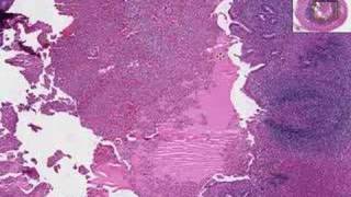 Histopathology Acute Appendicitis [upl. by Zwick]