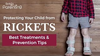 Rickets in children  Treatments and Prevention [upl. by Kavita]