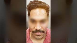 Severe Acne Treatment  3Month Transformation by Dr Amit Kerure  Navi Mumba [upl. by Aleras654]