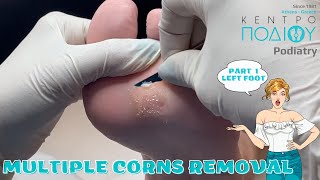 Corns Removal P1 feet κεντροποδιου foot podologos podiatrist corn footcare podiatry callus [upl. by Yaya]