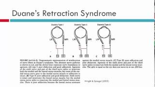 Duanes Retraction Syndrome Aetiology [upl. by Leaw871]