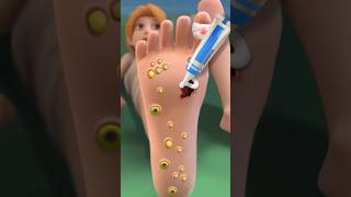 ASMR foot care remove big plantar worm amp psoriasis 2d animation treatment video [upl. by Aynekat]