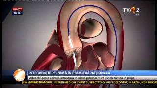 Premieră în România implantare de valvă aortică printro incizie de 5 cm în dreptul inimii [upl. by Olnton]