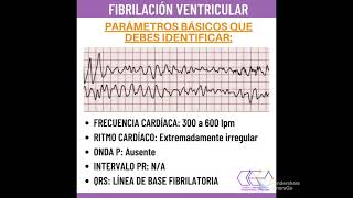 Fibrilación ventricular explicado en 1 minuto [upl. by Yasmine]