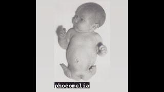 Phocomelia  A limb abnormality and a type of Meromelia [upl. by Irrot]