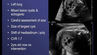 TMT Echogenic Lungs  Dr Alpana Joshi  CCAM  Pulmonary Sequestration  CPAM  Fetal Medicine [upl. by Dorothea]