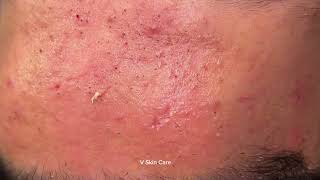 Special service to Get Rid Acne Remove ACNE FAST With These Treatment Secrets [upl. by Scully]