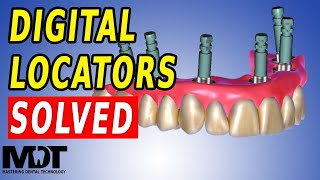 Fixed Locator Denture and NEW Digital Locator Library for ZEST Locators in Exocad 32 [upl. by Nesyrb]