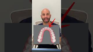 Quick Invisalign Case Study 2024 [upl. by Kecaj]