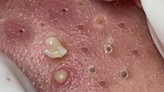 Nasa SPA 03 satisfying cyst relaxing blackhead pimple acne [upl. by Giglio]