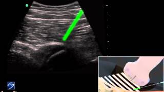 How To Hip UltrasoundGuided Injection of the Proximal Hamstring 3D Video [upl. by Nolrah]