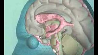 Causes of Normal Pressure Hydrocephalus [upl. by Anivlem]