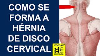 Como se forma a hérnia de disco cervical [upl. by Anahsar616]