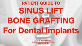 Patient Guide To Sinus Lift Bone Grafting For Dental Implants [upl. by Artemas311]