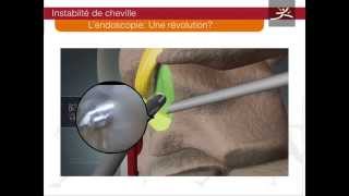 ligamentoplastie cheville arthroscopique type Brostrom Dr Guillo [upl. by Acinej827]