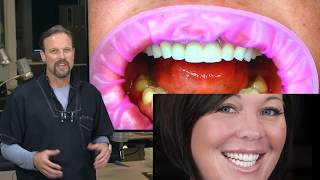 Veneers with CEREC [upl. by Humpage937]