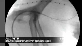 Interventional Radiology Percutaneous Ureteral Stent [upl. by Ariayek]