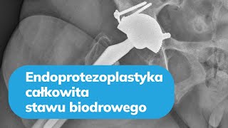 Endoprotezoplastyka całkowita stawu biodrowego  dr hab n med Ireneusz Babiak [upl. by Sherm562]