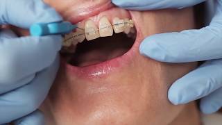 How to clean your around your braces with Gill from Elmsleigh House Dental Clinic [upl. by Jardena726]