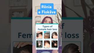 Renja e flokeve floket hairloss alopecia lekura hairlosstreatment floku imunitet vitamina [upl. by Noskcire]