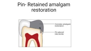 pin  retained amalgam restoration  Easy explanation [upl. by Naujyt885]