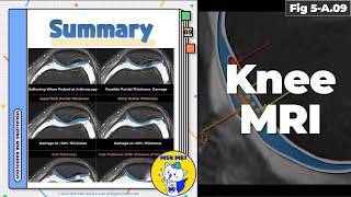 Fig 5A09 Summary of MRI Findings in Cartilage Damage [upl. by Ahseid980]