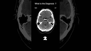 Fourth ventricle  CT brain CT Brain Anatomy CSF spaces Quiz 19 radiologychannel007 [upl. by Einahpit]