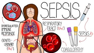 Understanding Sepsis Sepsis Explained Clearly [upl. by Aillicsirp992]