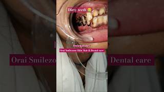 Dirty teeth 🤮lets clean shortfeed dentalcare oraismilezone drrichadubey dentist [upl. by Schrader]