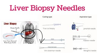 Liver Biopsy  Liver Biopsy Needles  Indications For Liver Biopsy  Types of Liver Biopsy [upl. by Flanna]