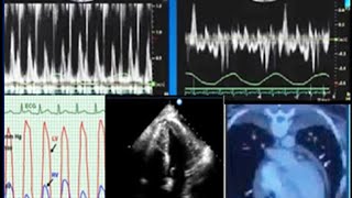 Constrictive pericarditis diagnosis echocardiography and treatment [upl. by Rinee]