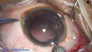 Management of Posterior capsular rent with intact anterior hyaloid Membrane  P Mohanta Oct  2023 [upl. by Llerrot]