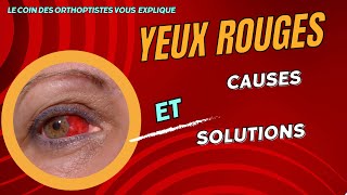 Yeux rouges et irrités Découvrez les solutions et les traitements [upl. by Mcgraw694]