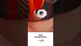 Laryngectomy Throat Cancer Surgery ↪ 3D Medical Animation Shorts Laryngectomy Throat Surgery [upl. by Lucas]