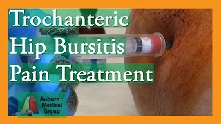 Trochanteric Hip Bursitis Pain Treatment  Auburn Medical Group [upl. by Snah]