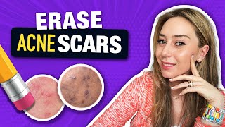 How to Treat amp Fade Acne Scars like a Dermatologist  Dr Shereene Idriss [upl. by Carn800]