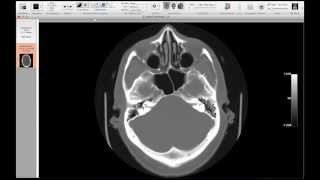 Christopher Hess MD PhD Neuroimaging Part 2 Fundamentals of Image Interpretation [upl. by Doerrer]