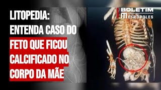 Litopedia entenda caso do feto que ficou calcificado no corpo da mãe [upl. by Reinar482]