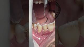 Dental problem of food impacts in deep caries dentist [upl. by Annil]