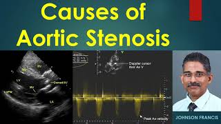 Causes of Aortic Stenosis [upl. by Radec968]