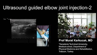 Ultrasound guided elbow joint injection2 [upl. by Aba]