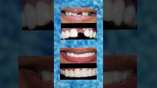 Tooth loss அ bridging technique மூலமா எப்படி சரி பண்ணலாம் [upl. by Ahsok817]